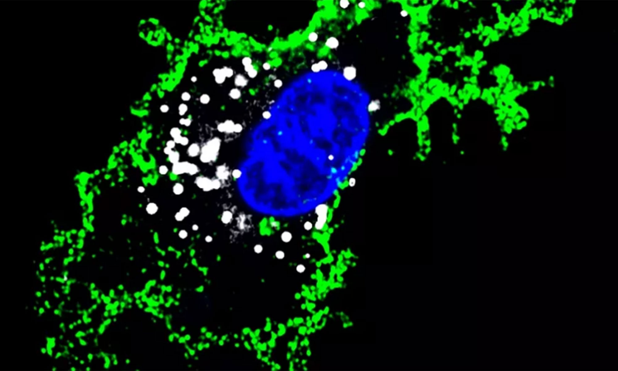 Immunsystemets skumceller hjälper hjärntumören att växa