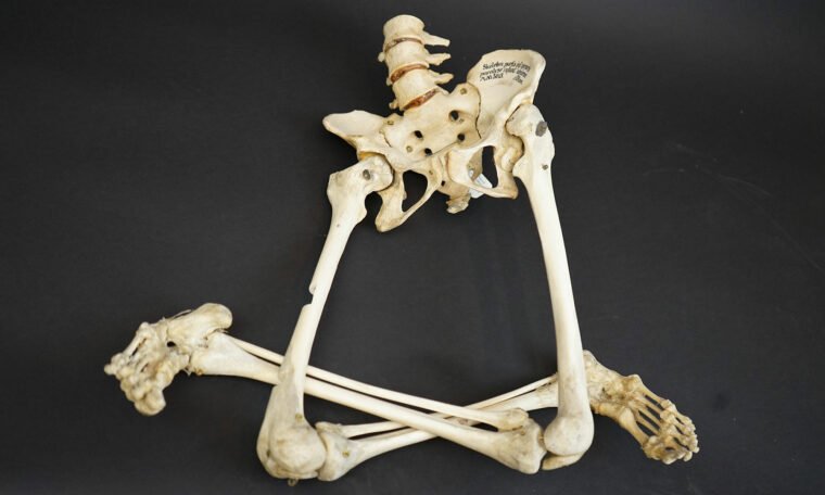 skelett visar på polio