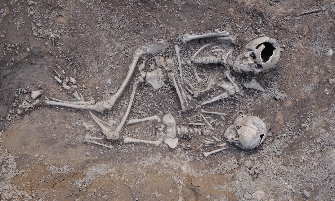 Skelett som visar på polio i en medeltida grav